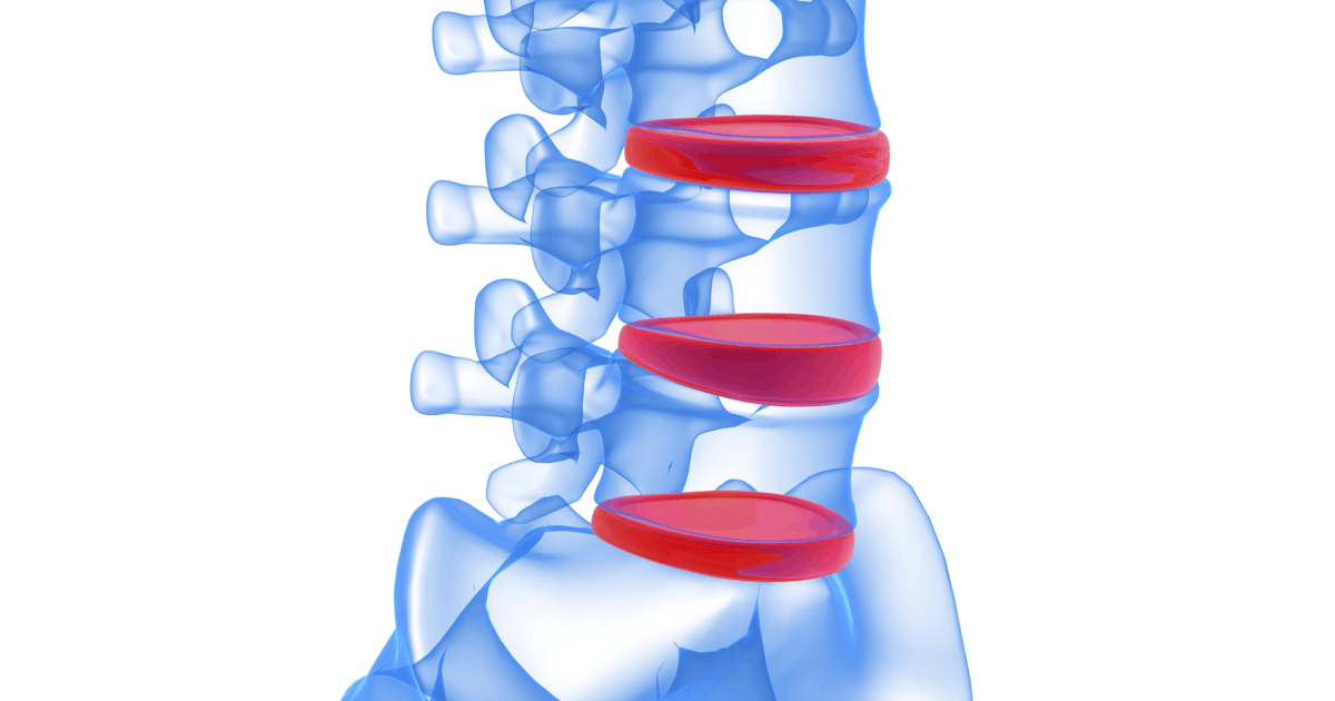 illustration of human spine with lumbar discs highlighted