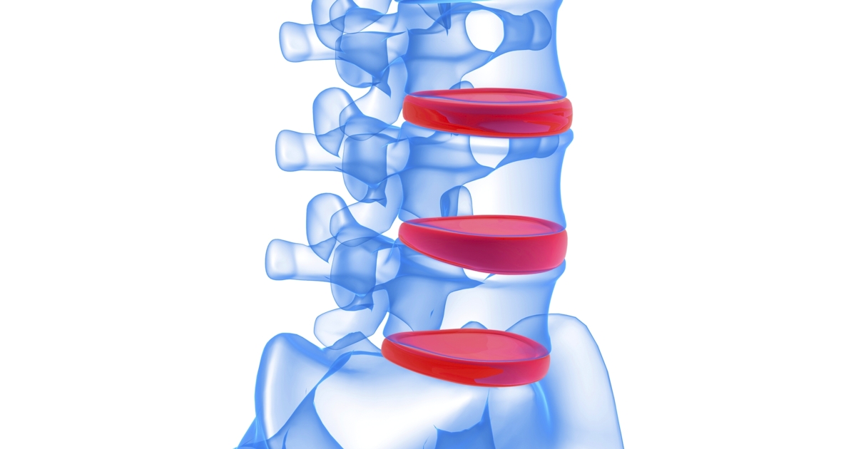 illustration of human spine with lumbar discs highlighted