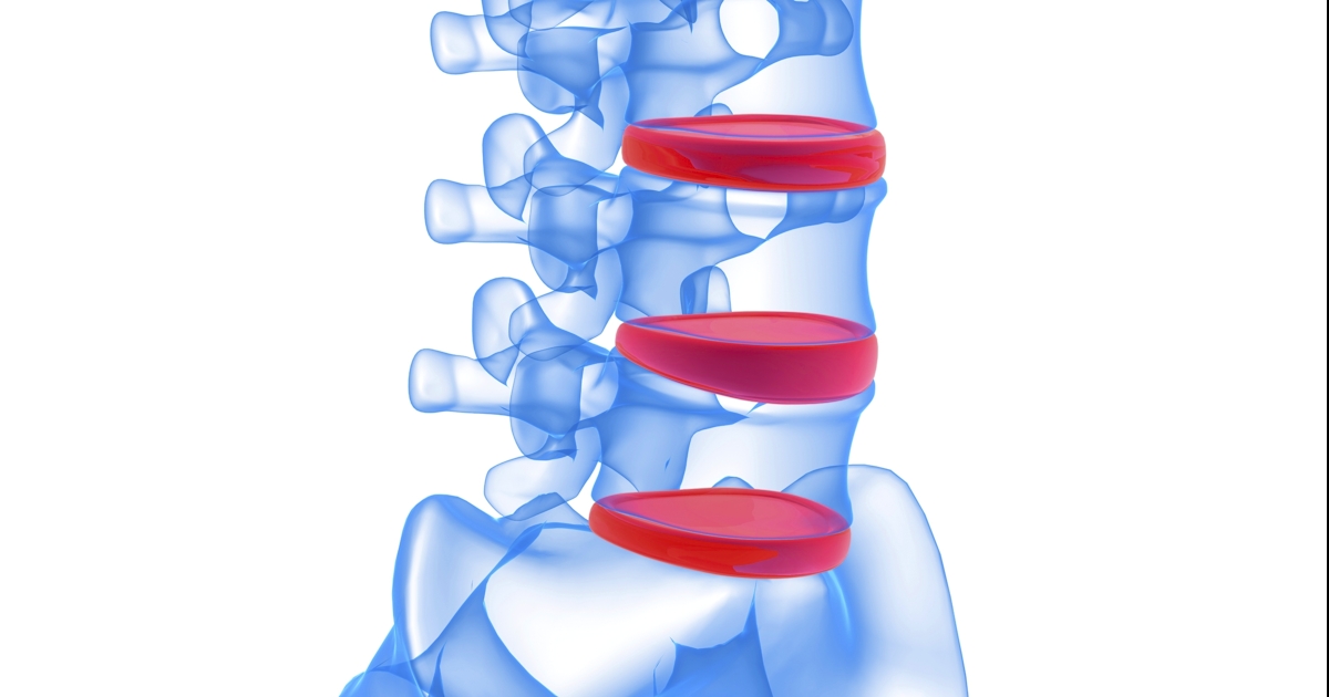 Spinal Cord Compression  Accident Care Chiropractic
