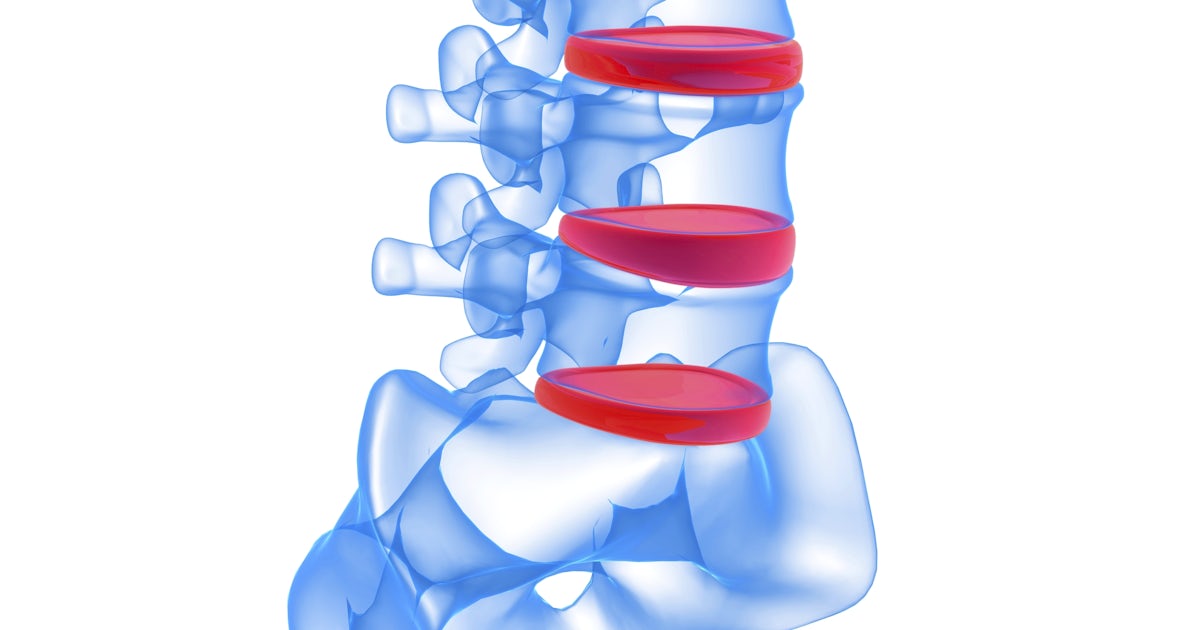 illustration of human spine with lumbar discs highlighted