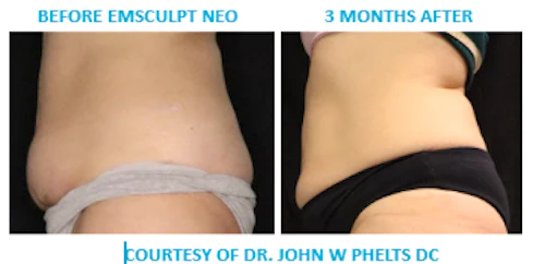 Abs Lateral Results