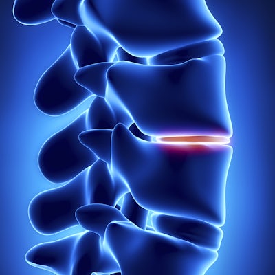 illustration of spine with a highlighted disc
