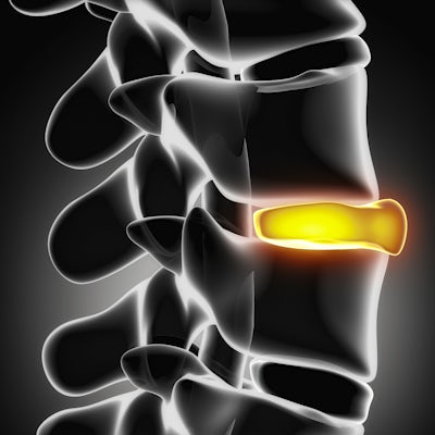 Illustration of a highlighted spinal disc ruptured in x-ray view