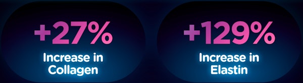 Figure 3: EMFACE combines HIFES and RF energies, resulting in dual-action facial rejuvenation. Figure 3: EMFACE combines HIFES and RF energies, resulting in dual-action facial rejuvenation.