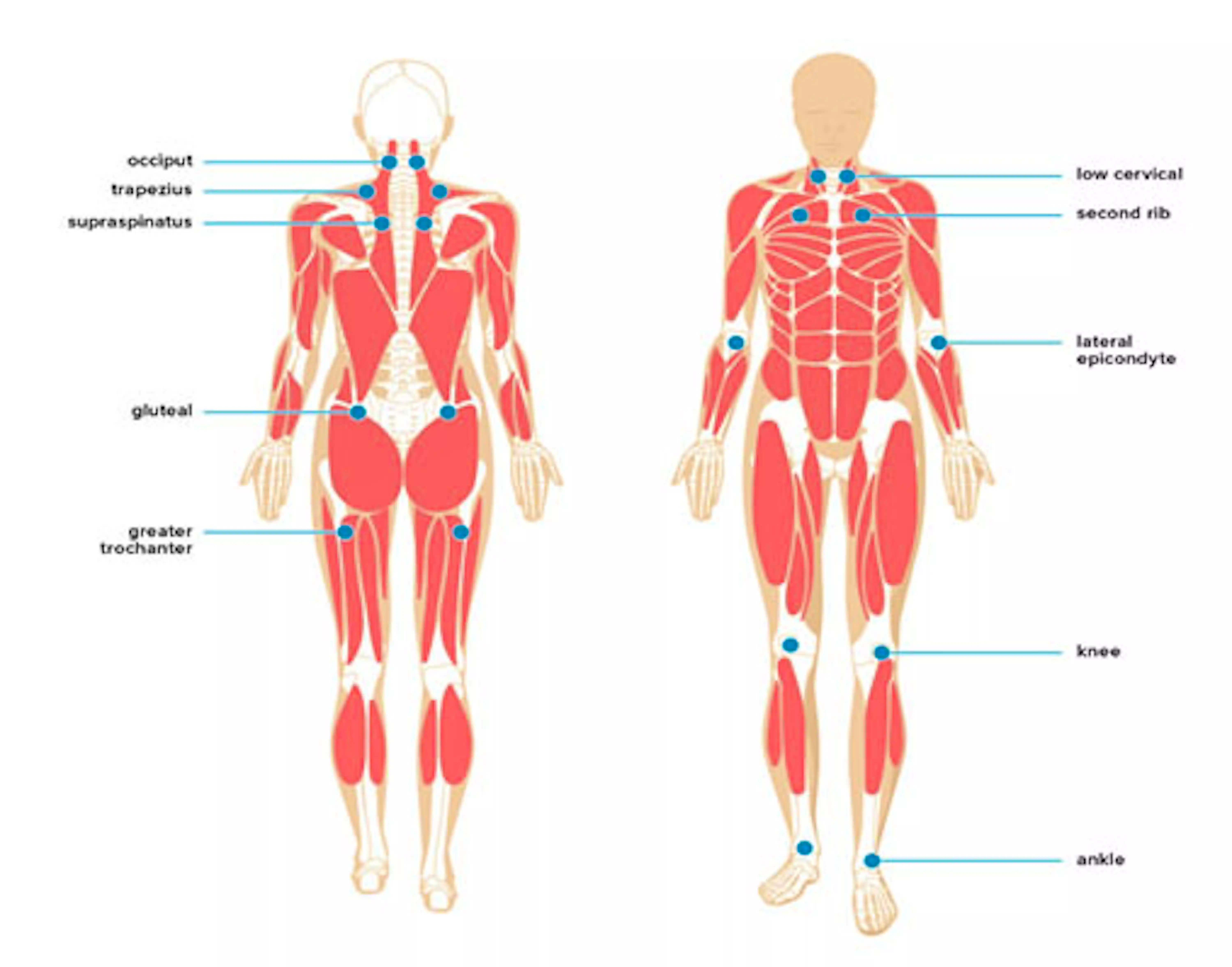 Muscle Nodules How Dry Needling Works? | Joondalup, Perth Chiropractor | Lakeside ...