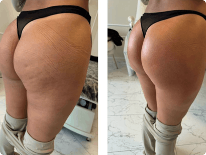 Before and after results — T-Shape treatment (set 2)