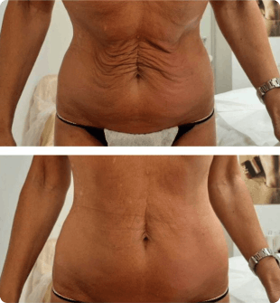 Before and after results — T-Shape treatment (set 3)