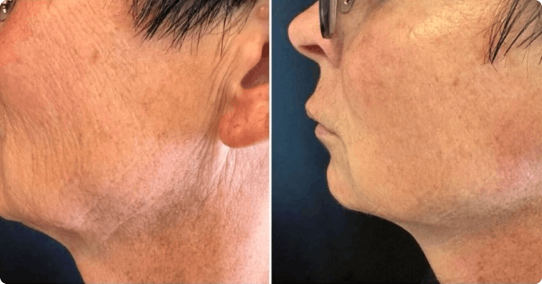 Before and after results — T-Shape treatment (set 1)