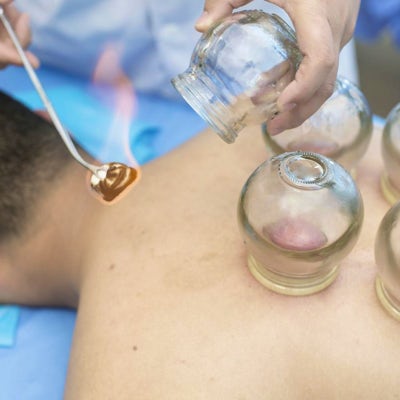 Fire cupping at Natural Family Chiropractic