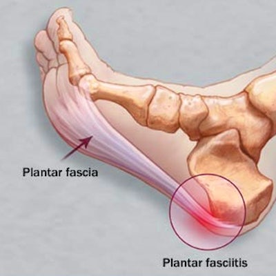 Plantar Fasciitis Treatment