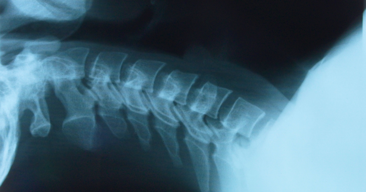 X-ray of neck