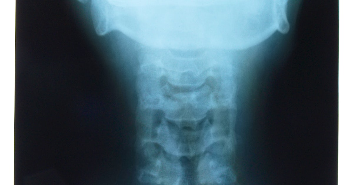 X-ray of neck from rear