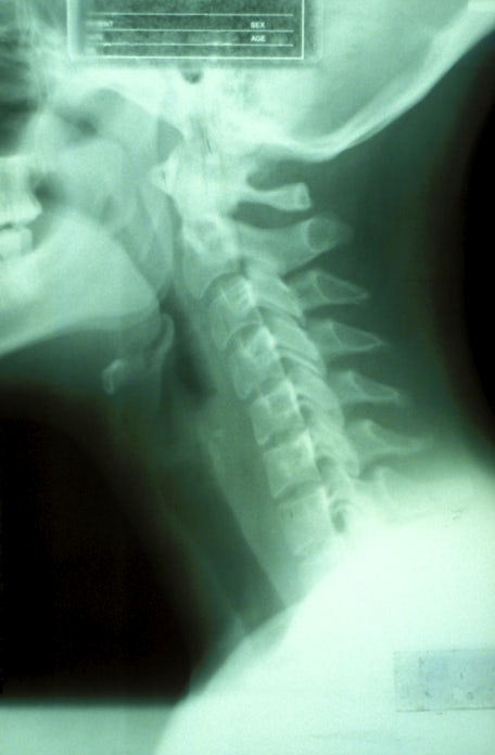 x-ray of neck from side
