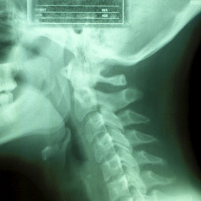 x-ray of neck from side