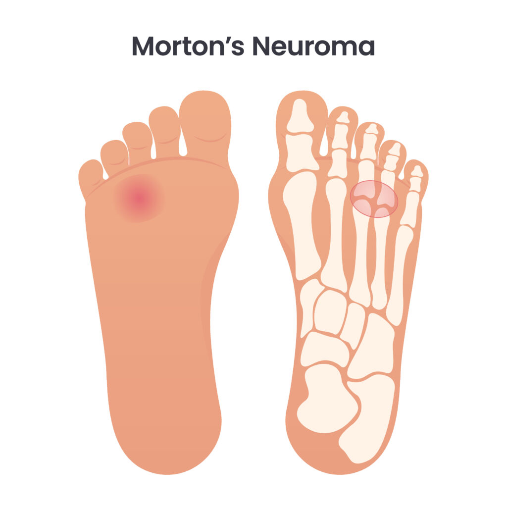 Pain site for Morton's neuroma, forefoot pain, chiropractic
