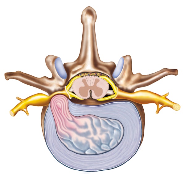 HerniaDisco20