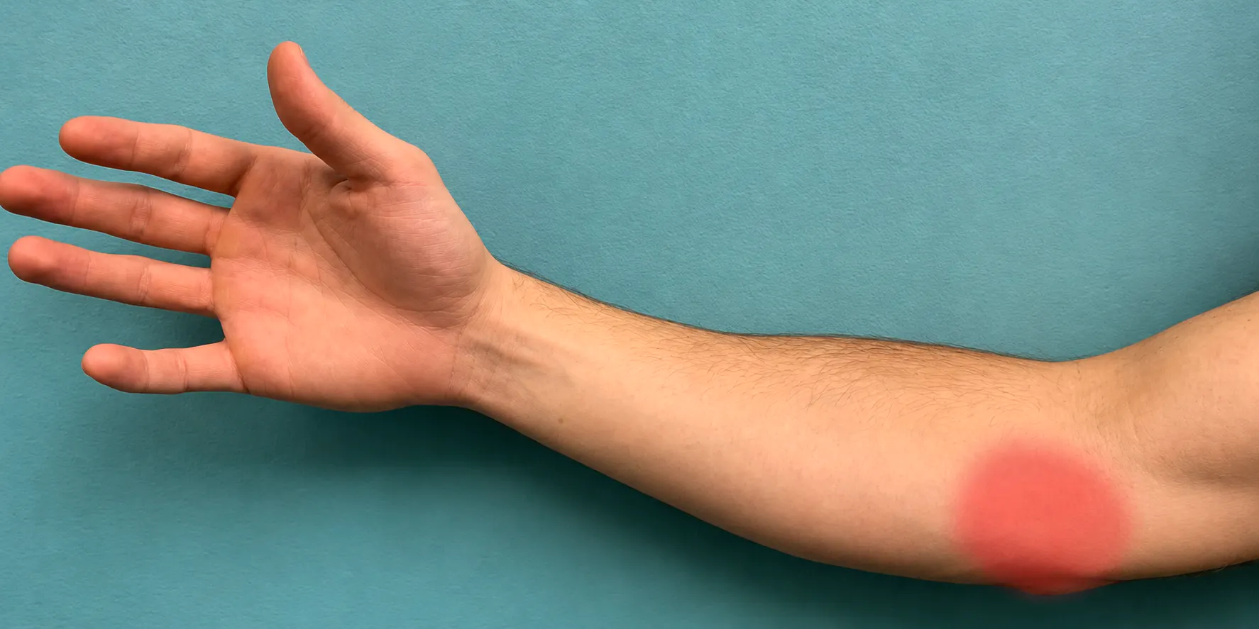 Arm with redness at the inner elbow showing golfer's elbow and medial tendon pain