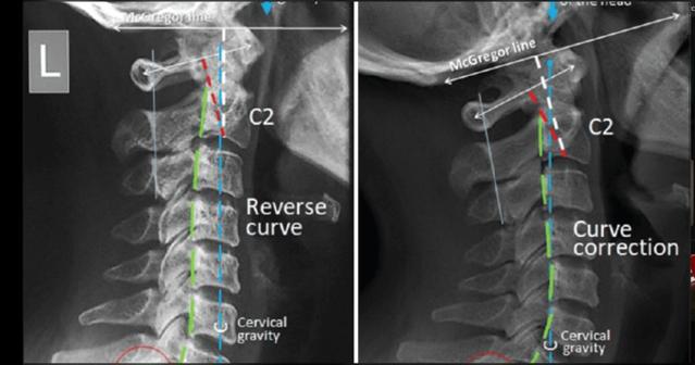an x-ray of the upper spine, showing two different curvatures