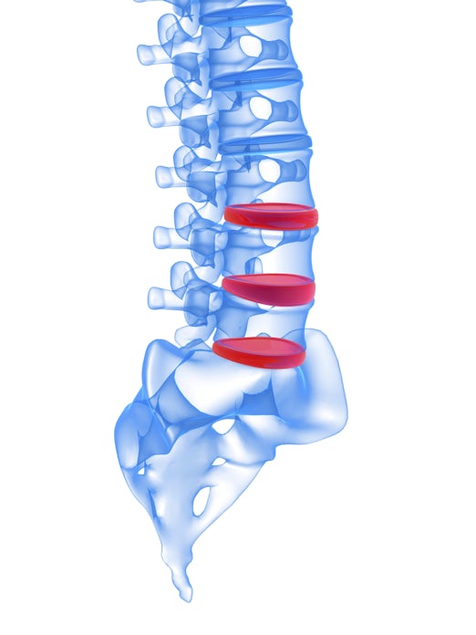 The image depicts a 3D illustration of a human spine, highlighting intervertebral discs in red between the vertebrae.