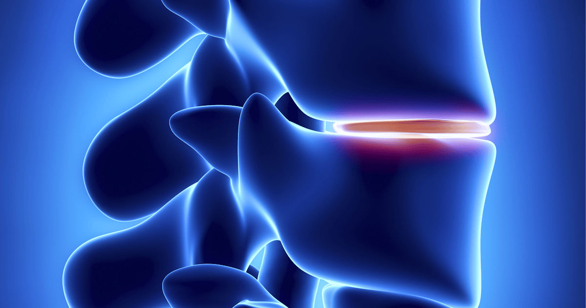 Understanding Disc Compression: Symptoms and Relief Through ...