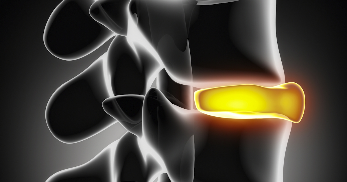 The image shows a digitally rendered human spine with a highlighted intervertebral disc, indicating potential injury or focus on spinal anatomy.