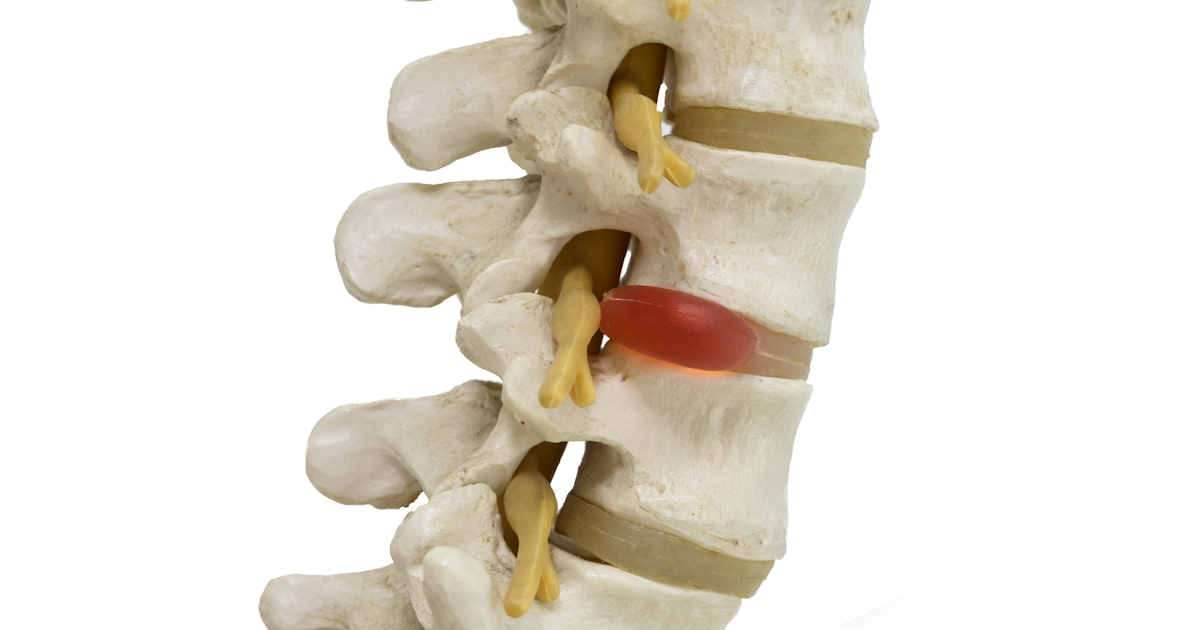 Close-up view of herniated lumbar vertebral disc m