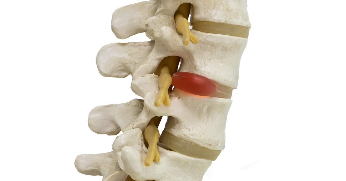 Close-up view of herniated lumbar vertebral disc m