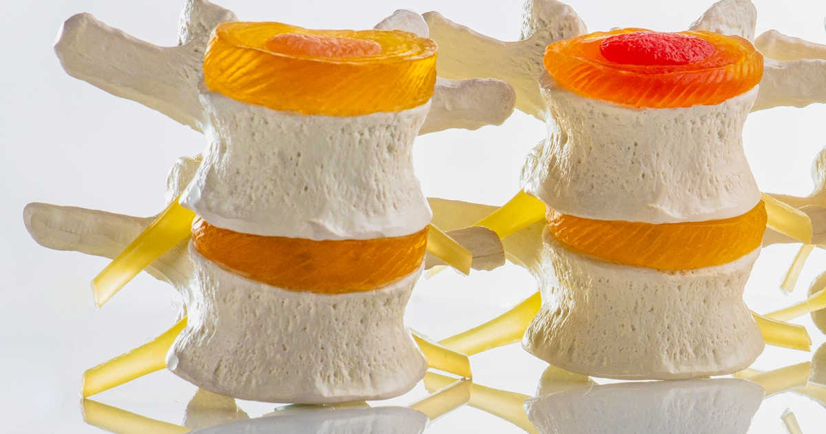 Vertebrae and discs. Neurodegenerative disease.