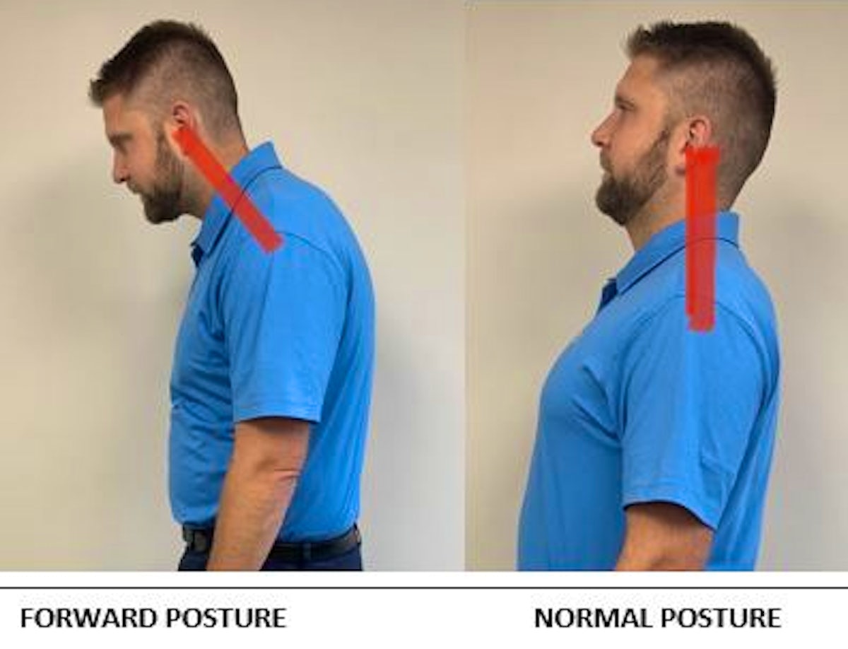 forward posture image