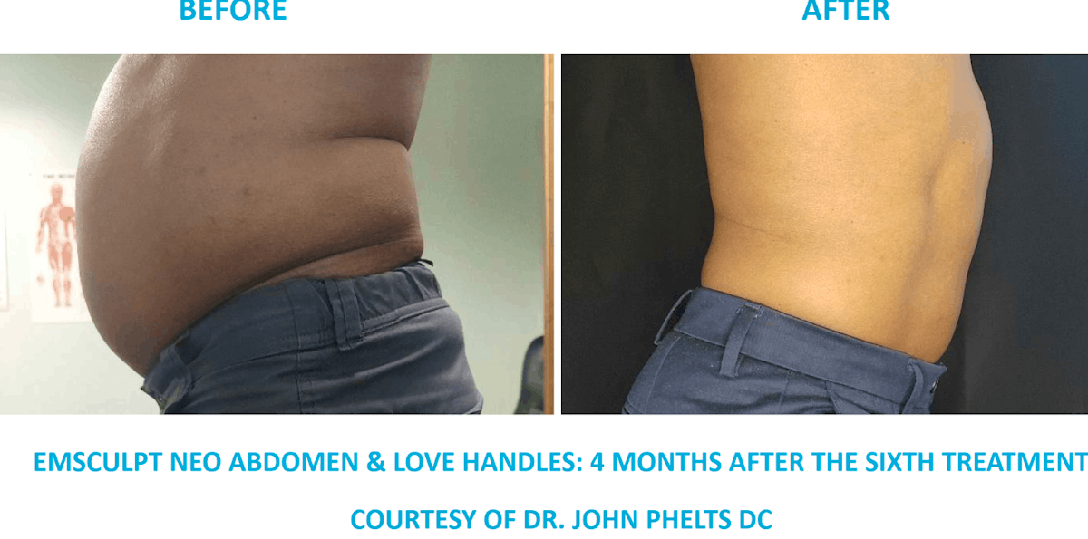 EMSCULPT NEW ABDOMEN AND LOVE HANDLES - BEFORE AND AFTER