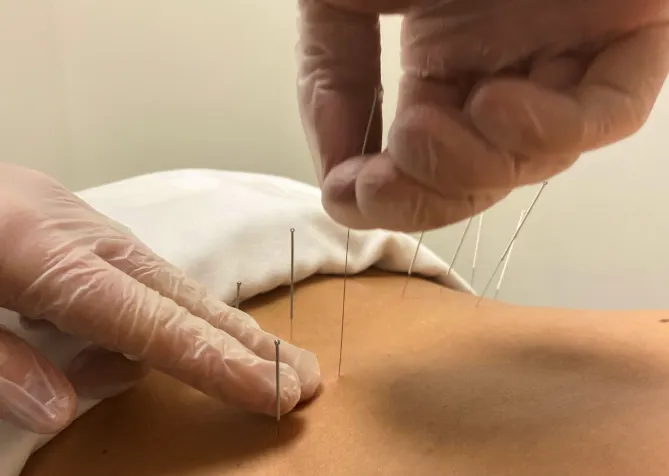 Dry needle treatment applied to the lower back for sciatica, nerve pain, and muscle tension relief