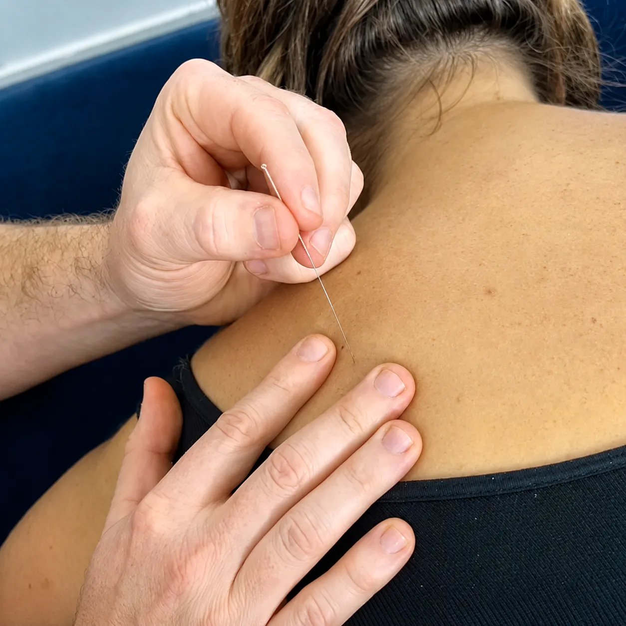 Dry needle treatment applied to the upper back and shoulder for subacromial bursitis and muscle tension