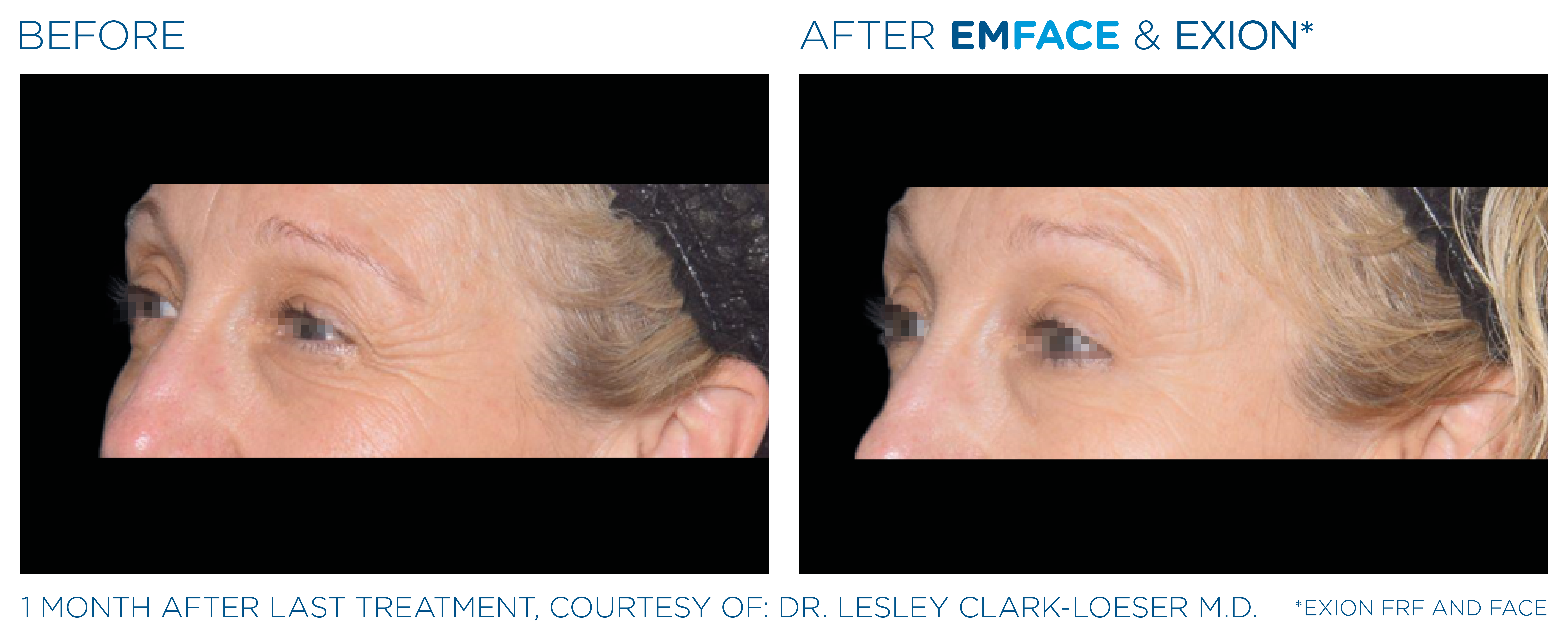 Female Eyes EMFACE Before and After