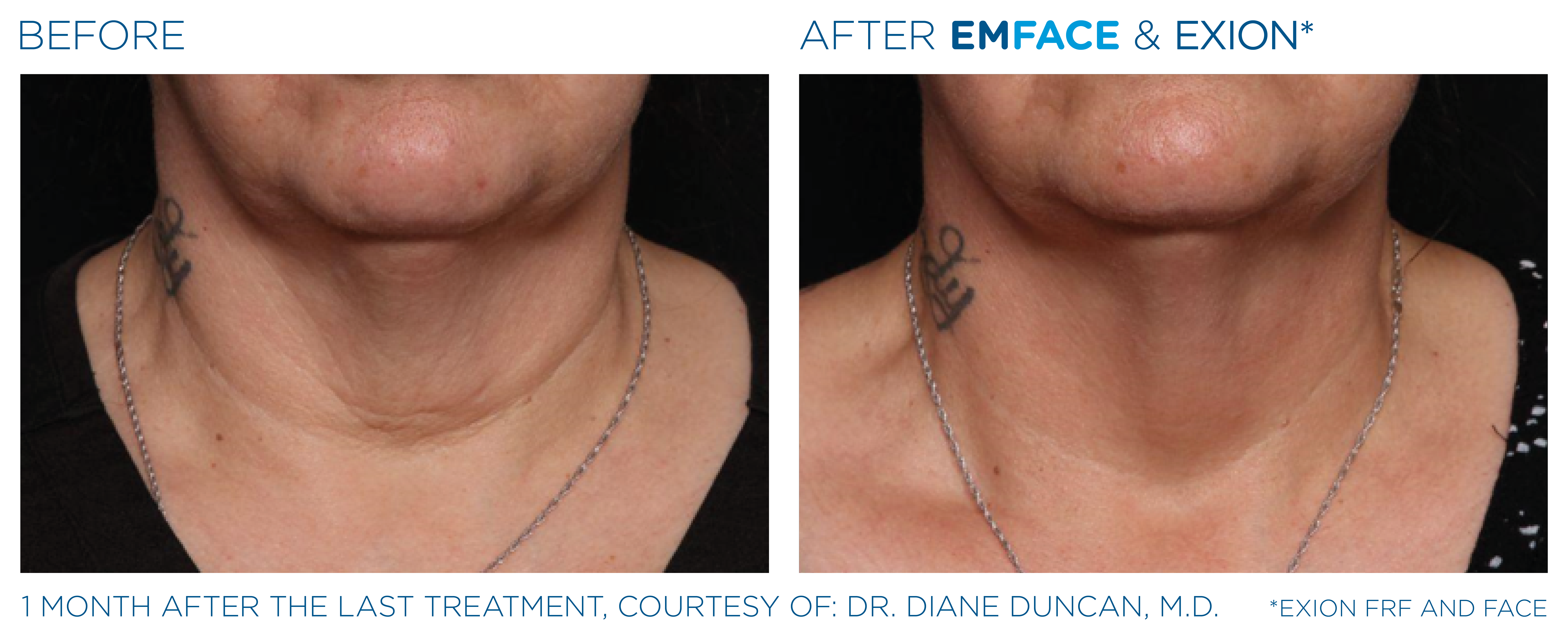 Female Neck and Chin EMFACE before and after
