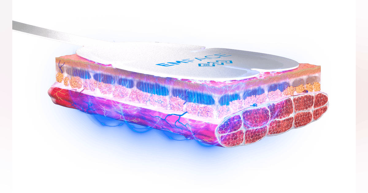 EMFACE HIFES % RF +23% lift -36% wrinkles 95% patient satisfaction. Prices in NYC