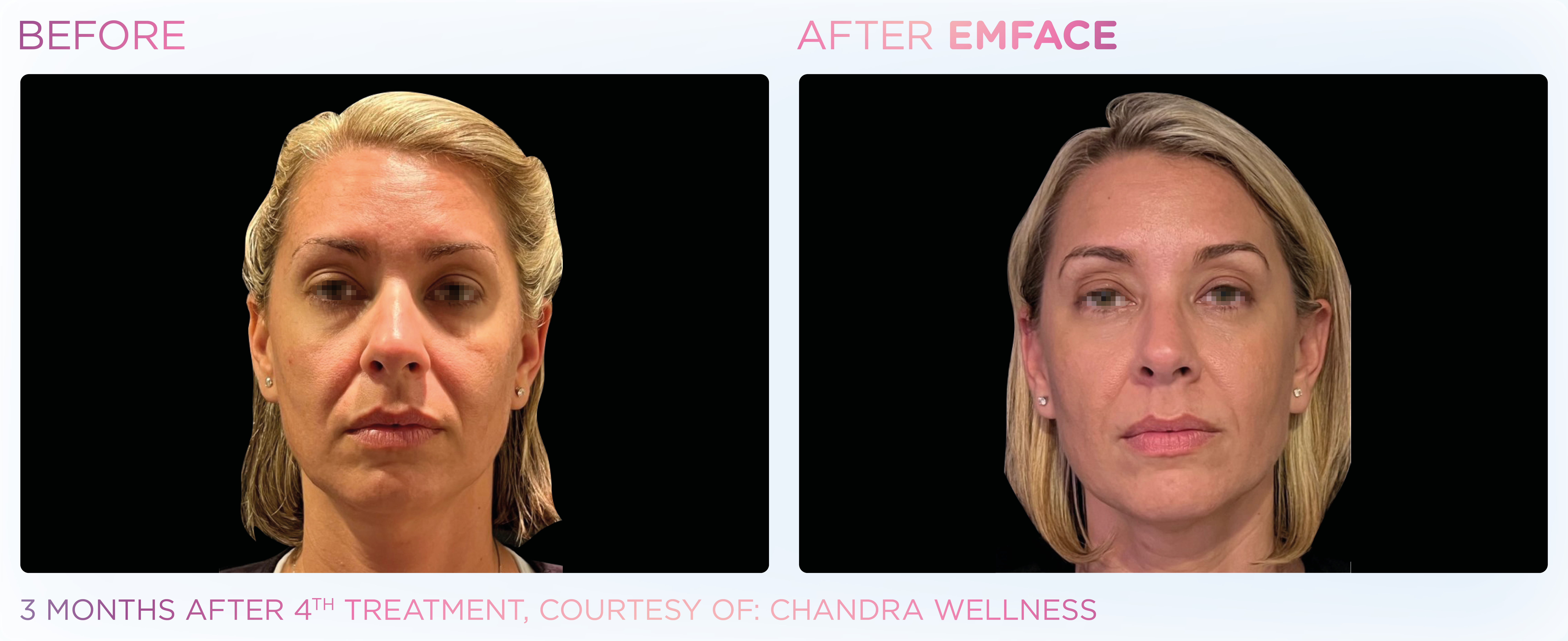Female Full Face EMFACE before and after