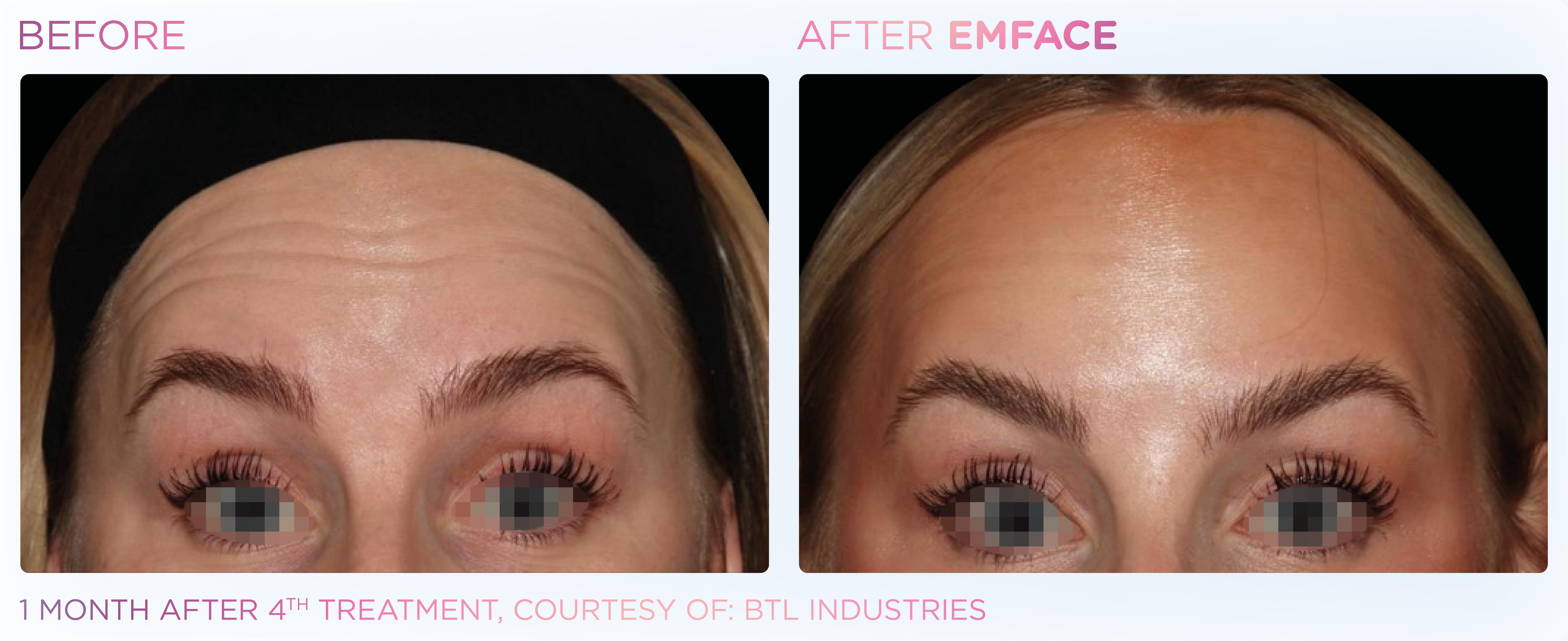 Female Forehead EMFACE before and after