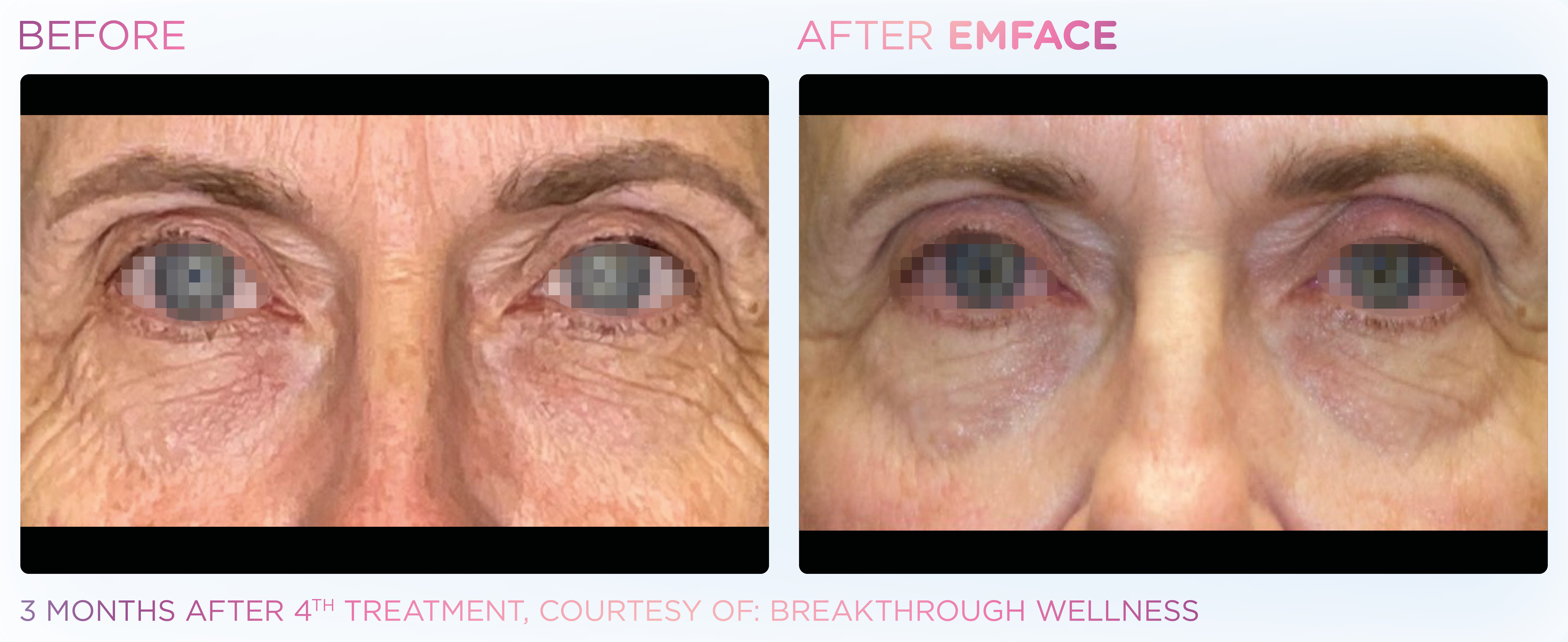 Male Eyes EMFACE before and after