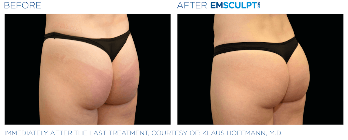 Emsculpt