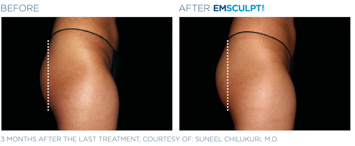 Emsculpt NEO Butt Lift Prices NYC