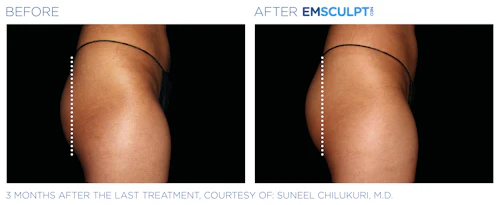 Buttock Enhancement