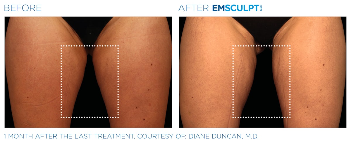 Emsculpt