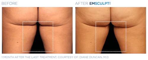 Inner Thigh Results