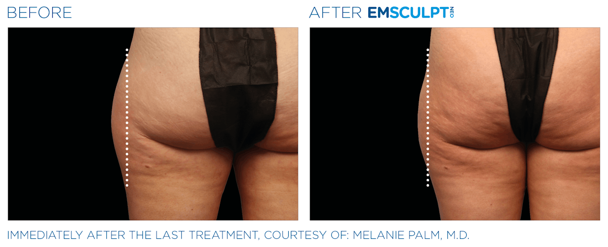 Emsculpt