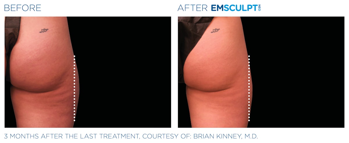 Emsculpt
