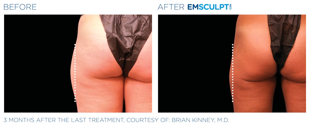 Emsculpt
