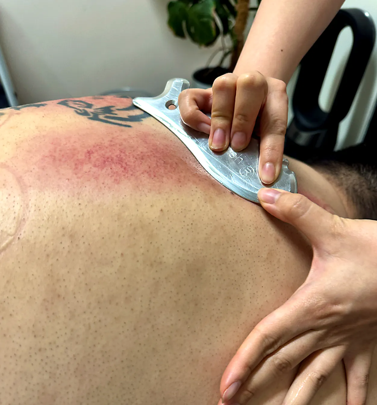 Graston Technique therapy applied to the upper back and neck for cervical osteoarthritis and neck stiffness