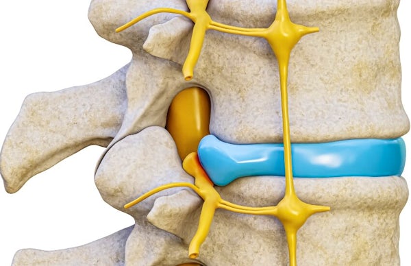 Herniated disc treatment in Salem and Aloha OR