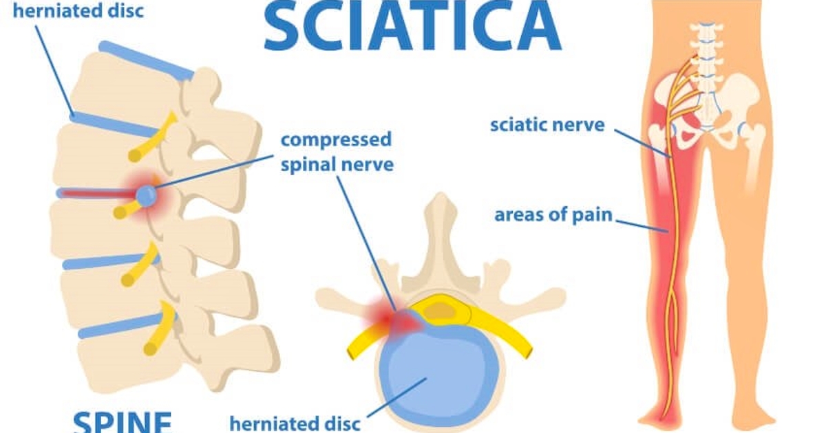 Sciatica and how it is treated with stem cell therapy