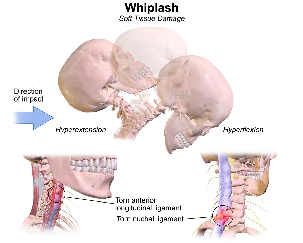 Illustration of whiplash injury showing hyperextension and hyperflexion in the neck highlighting soft tissue damage torn ligaments and cervical spine impact